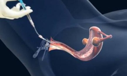 试管移植后第二天女性提了6斤的重东西要紧吗？